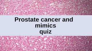 Prostate Cancers and Mimics Quiz - 10 Cases