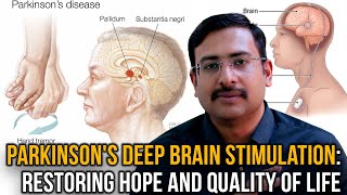 Parkinson's Deep Brain Stimulation: Restoring Hope and Quality of LifeDr. Hariharasudan Ranganathan