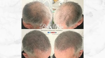 Scalp Micropigmentation - Density - Before, 1st and 2nd Session