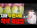 누렇게 착색된 내 치아! 하얘질 수 있다고?! | 착색의 원인과 해결법 대공개!