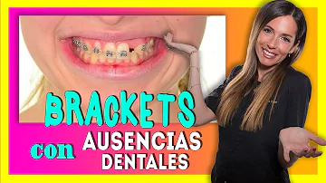 ¿Los brackets separan los dientes?