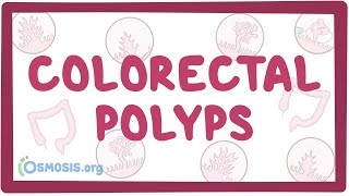 Colorectal polyps - an Osmosis Preview