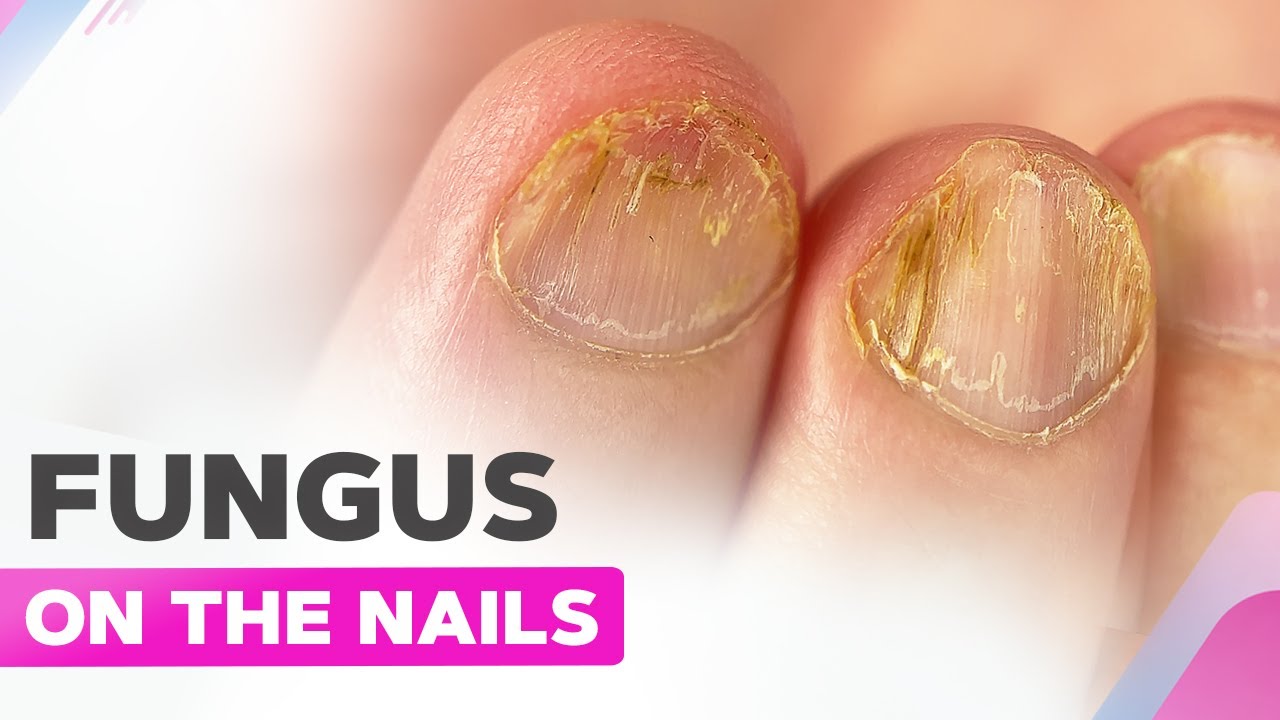 How I Cured My Nails | Shocking Experience | Restoring Nails from Bacteria  - YouTube