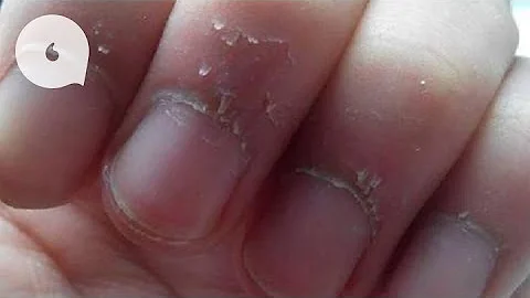 【動畫】倒刺會自動好番唔使撕走　唔關缺乏維他命事 - 天天要聞