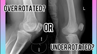 How to Fix a Lateral Knee