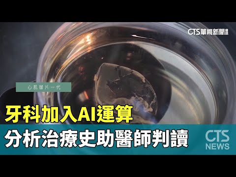 牙科加入AI運算 分析治療史助醫師判讀｜華視新聞 20231130