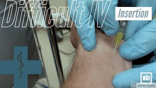 difficult IV insertion