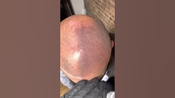 Up close look at Scalp Micropigmentation (halfway through)