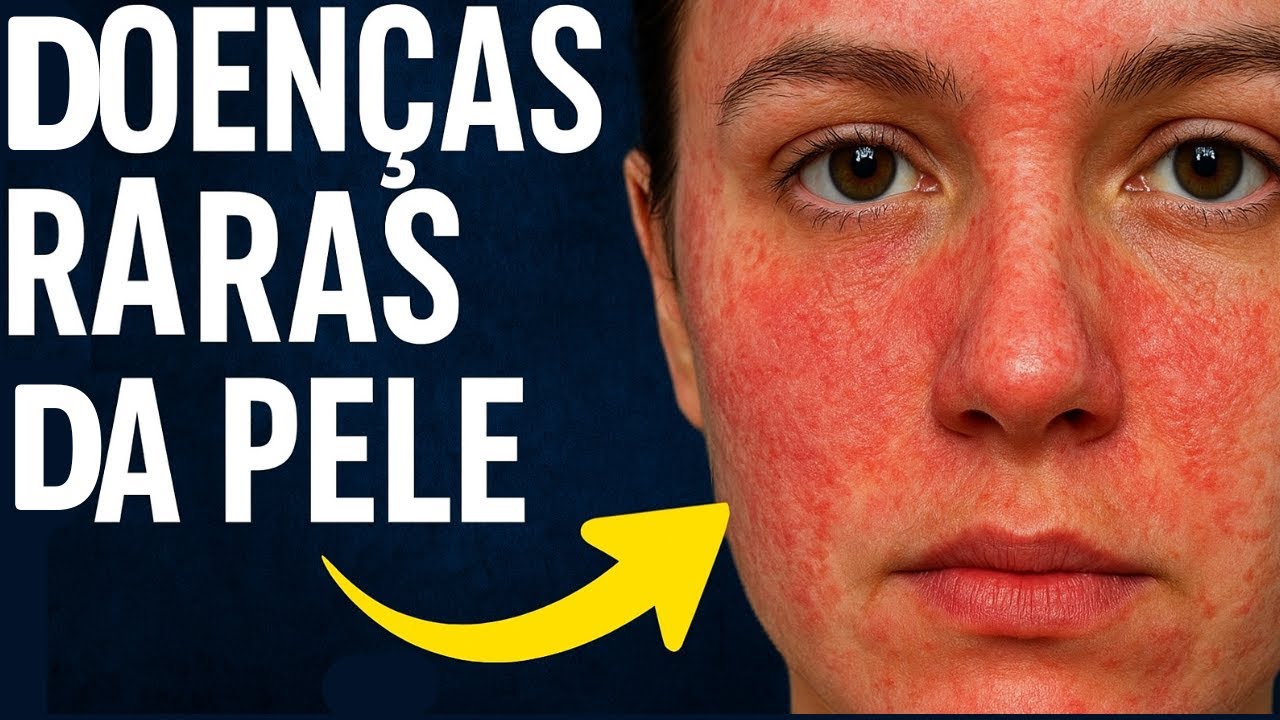 Lesiones Raras Doenças rara da Pele: Desvendando o Incomum - YouTube