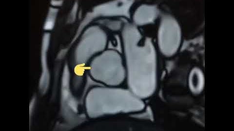 CINE TRUEFISP of Heart Cardiac MRI