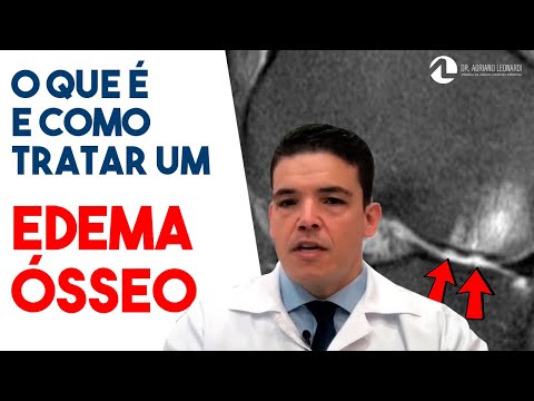 Vídeo: Edema Da Medula Óssea: O Que é E O Que Causa Isso?