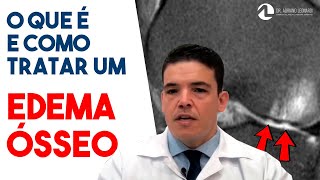 Edema Ósseo E Fratura Subcondral Diagnóstico, Causas E Tratamento