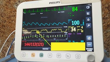 Cardiac Oscillations in Capnograph (End Tidal CO2, EtCO2) #ICU