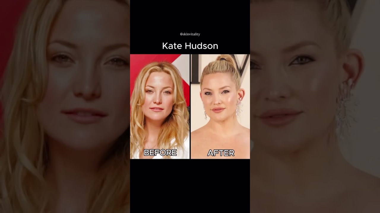 Celebrity-Inspired Glow Ups: Hailey Bieber, Sofia Richie & More | Medspa B&As