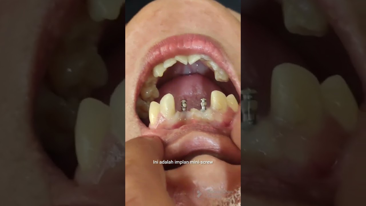 Tukang Gigi Si Paling Implan dari Jambi | KorTuGi