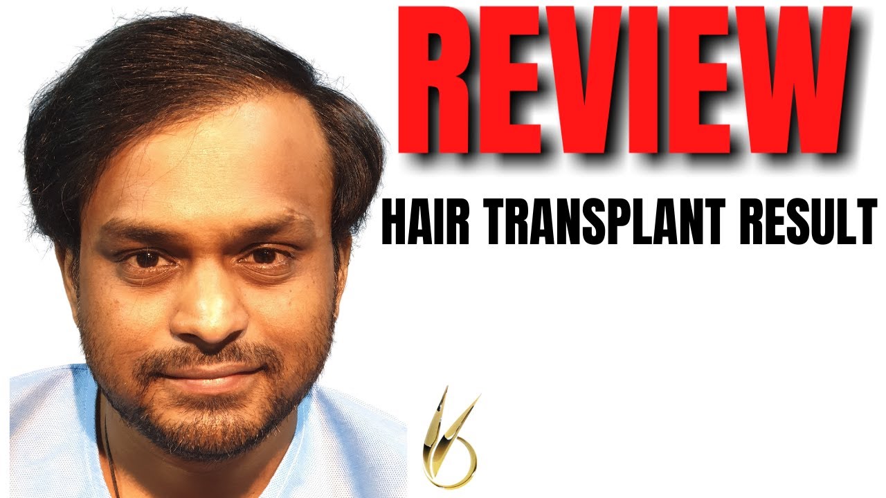 Best Hair Transplant in Chandigarh - Hair Transplant Cost in Chandigarh
