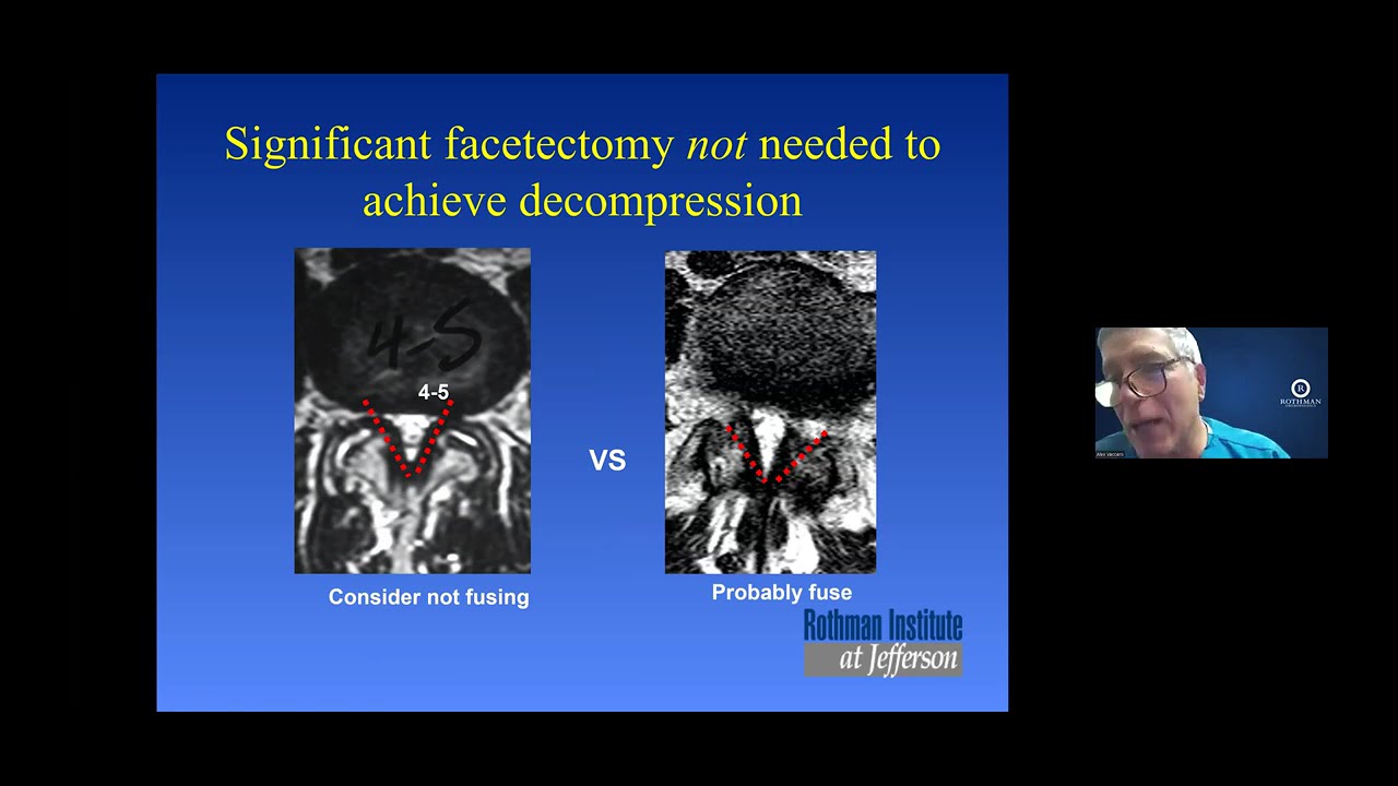 Rothman Webinar - Lumbar Spondylolisthesis: A Common Cause of Back and Leg Pain