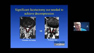 Lumbar Spondylolisthesis: A Common Cause of Back & Leg Pain– A Webinar from Dr. Alexander R. Vaccaro