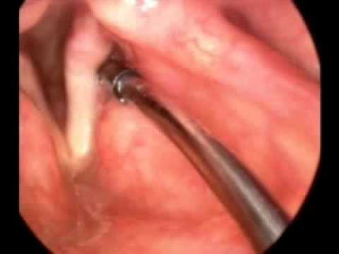 Presbyphonia - Injection Laryngoplasty