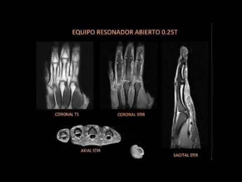 Vídeo: Modalidades De Imagen En La Osteoartritis De La Mano: Estado Y Perspectivas De La Radiografía Convencional, La Resonancia Magnética Y La Ecografía