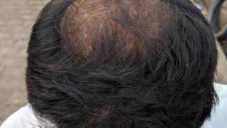 Minoxidil 5%, Finasteride 1mg & Derma roller 1.0mm , 3 month hair grow result