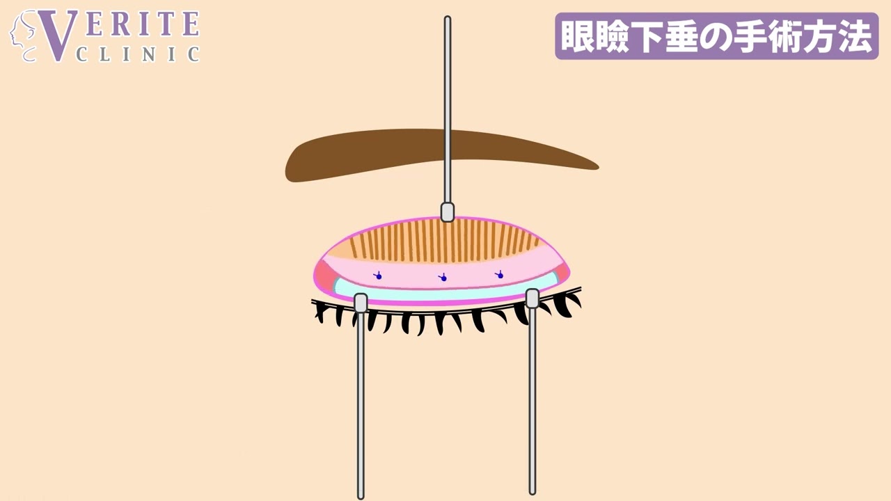 眼瞼下垂 | 美容整形・美容外科のヴェリテクリニック【公式】 東京