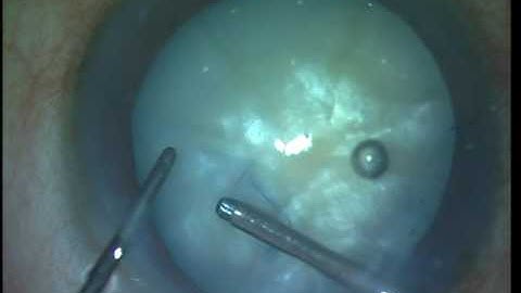 White cataract phaco for beginners Part 2 Soosan Jacob with audio 8 min