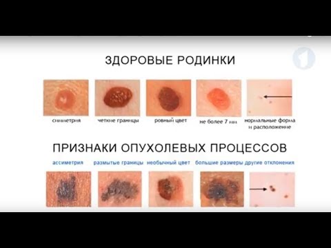 Видео: Причини за рак на кожата: плоскоклетъчна клетка, базална клетка, меланом
