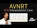 AV Nodal Reentry Tachycardia (AVNRT) on ECG / EKG