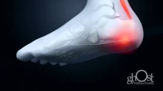 Medical Animation: Vionic - Orthaheel