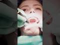 Ultrasonic cleaning of tartar &amp;calculus#dentist #health #teeth #dentalcleaning #dental #shorts