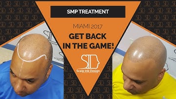 Scalp Micropigmentation in Miami (SMP Hair) - Chad