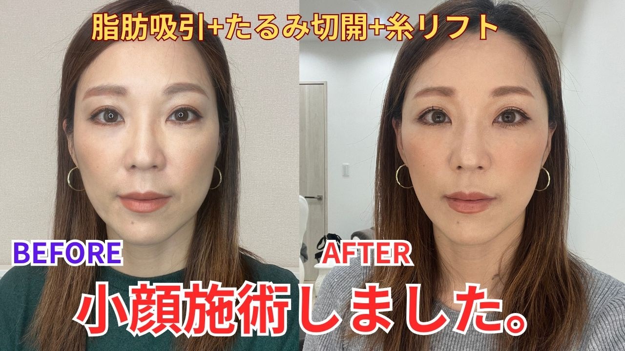 【美容】43歳!フェイスリフトで小顔&若返りました!