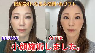 【美容】43歳!フェイスリフトで小顔＆若返りました!