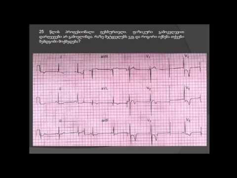 ჰიპერტროფიული კარდიომიოპათია (ექოკ: პარკუჭთაშუა ძგიდის ასიმეტრიული ჰიპერტროფია, ვენტურის ეფექტი)