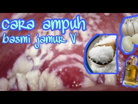 Cara ampuh menghilangkan keputihan || INFEKSI JAMUR V491na