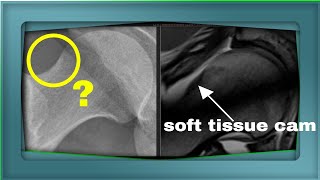 Soft tissue cam lesion on hip MRI screenshot 4