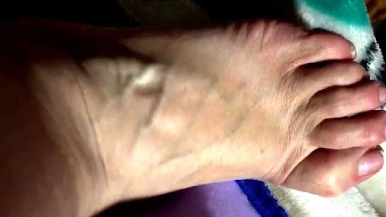 Foot cramp that looks like a worm in my foot. Watch the left lower side of my foot! YouTube