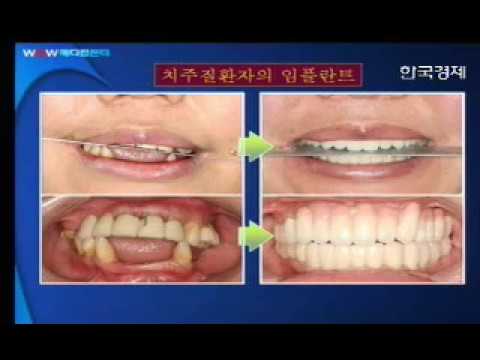 [라임나무치과병원]김인수 원장이 소개하는 노년층을 위한 임플란트