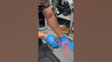 Interne *STUITJE* staartbeencorrectie