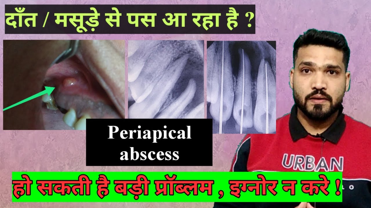मुँह से पस आ रहा है ? Periapical abscess ? Problem & treatment