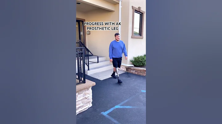 Above-Knee Amputee Progress | James Using the X4 Microprocessor Knee