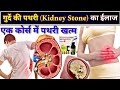 गुर्दे की पथरी का बेस्ट ईलाज // Kidney Stone treatment // Renal calculi // Nephrolithiasis treatment