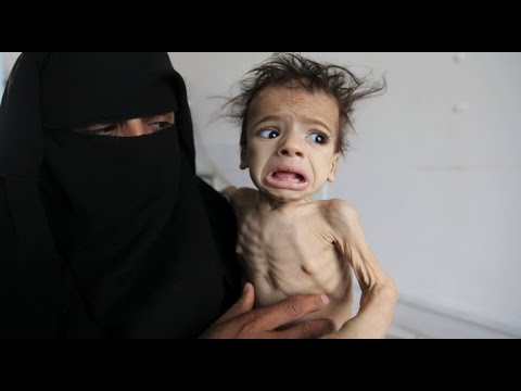 Image result for starvation in yemen