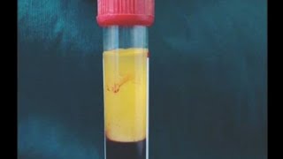 i decided to do a kidney test for myself UECs