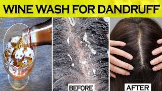 Wine Wash for Severe Dandruff Problem | How To Remove Dandruff | White Flakes & Itchy Scalp