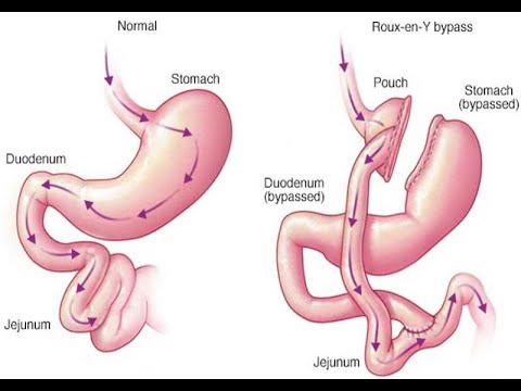 Λαπαροσκοπικό Γαστρικό Bypass-Νοσογόνος Παχυσαρκία