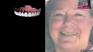#Mobile #Dentures  #Highlight from  Recent #Presentation at #3DHEALS2024 #Dental3DPrinting
