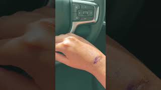 Needed to be done #ganglioncyst #cyst #surgery #surgeryrecovery