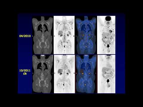 Video: Multipelt Myelom: Symptom, Behandling, Diagnos, Prognos